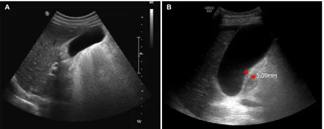 Fig. 1. Abdominal US. (A) US obtained before taking sunitinib showing a normal GB without stones