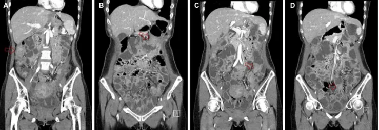 Fig. 1. Abdominal computed tomography demonstrated multiple strictures with proximal bowel dilatation in the (A) ascending, (B) transverse, and (C, D) sigmoid colon (arrows).