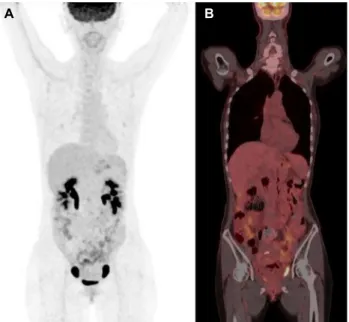 Fig. 2. Colonoscopy findings. (A, B) Mass-like lesion with surface reddish nodularity and luminal stenosis is noted at the sigmoid colon, 30 cm from the anal verge