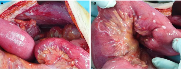 Fig. 4. (A, B) Exploratory laparotomy shows multiple small whitish nodules disseminated on the whole small and large bowel combined with  adhesion and stricture