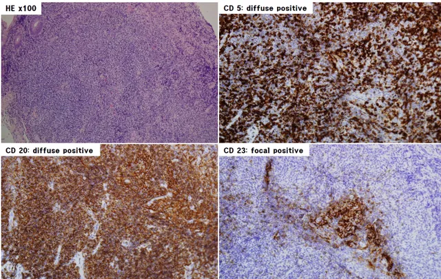 Fig. 2. Histological and immunohistochemical findings of the patient. Biopsy of stomach and colon revealed lymphoepithelial lesion with  diffuse positivity of CD20 and 5 and focal positivity of CD23 (upper left: H&amp;E, ×100; upper right: CD5 [diffuse pos
