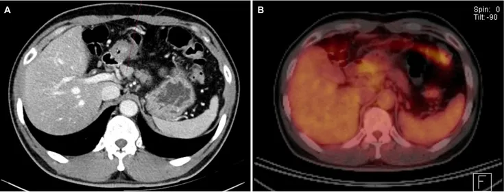 Fig. 3. Findings of abdominal pelvic CT and 18F-fludeoxyglucose PET/CT. (A) Porto-caval lymph node enlargement was observed upon CT (thin red arrow)