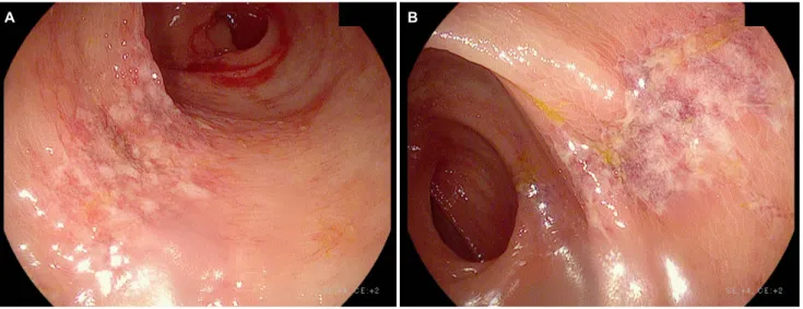 Fig. 2. Abdominal computed tomography revealed submucosal edema of transverse colon (A) transverse section and (B) coronal section.