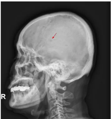 Fig. 2. Skull X-ray image (lateral view). Multiple punched-out osteolytic lesions are scattered in numerous sizes (red arrow).