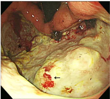Fig. 2. (A, B) Abdominal computed tomography shows diffuse wall thickening in the stomach with a suspected ulcerative lesion (arrows) in the lesser curvature side of the gastric antrum and perigastric infiltration.