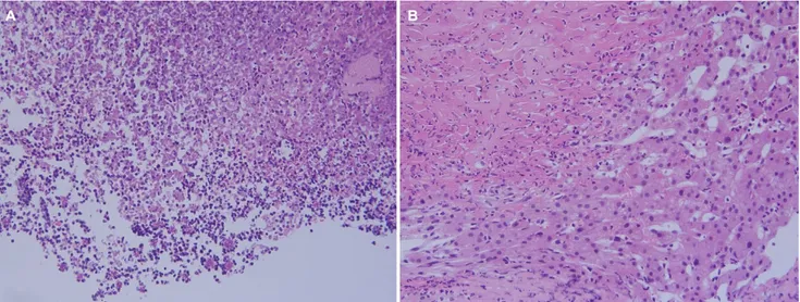 Fig. 4. (A) An endoscopic biopsy demonstrated neutrophils aggregates and necrotic debris, indicative of the findings of an ulcer bed (H&amp;E, 