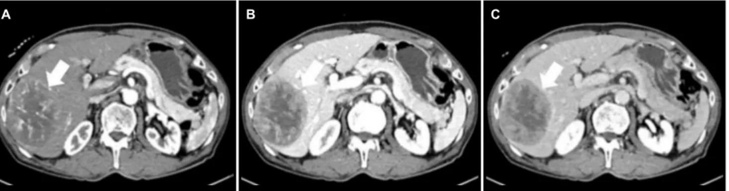 Fig. 1. Triple phase computed tomography of the liver at diagnosis. (A) A 9 cm sized heterogeneous enhancing mass of the right hepatic lobe at the arterial phase (white arrow)