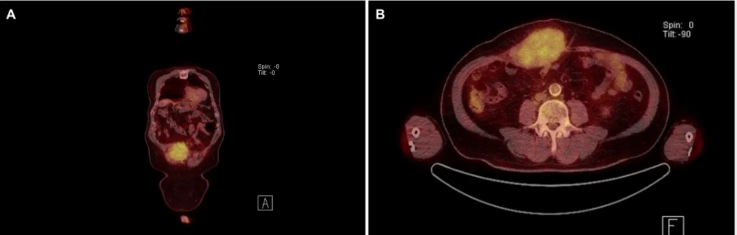 Fig. 2. (A, B) Positron emission tomography-computed tomography findings. Hypermetabolic mass lesion was noted in the right rectus abdominis muscle