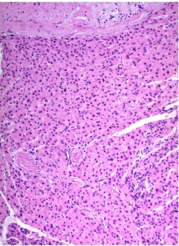 Fig. 5. Microscopic findings demonstrating a trabecular pattern,  polygonal-shaped tumor cells with eosinophilic cytoplasm, and mild to moderate nuclear atypia, suggesting well to moderately  differentiated hepatocellular carcinoma (H&amp;E, ×100).
