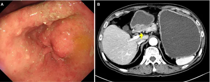 Fig. 4. Gross and histopathology findings. (A) Cut sections of the whitish solid mass that invaded the subserosa