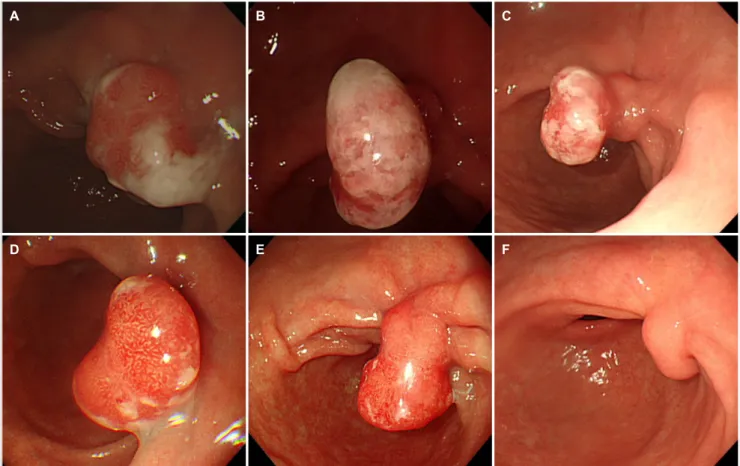 Fig. 2. Long-term follow-up of the hyperplastic polyp. Endoscopic surveillance was performed annually or biennially after the endoscopic  treatment