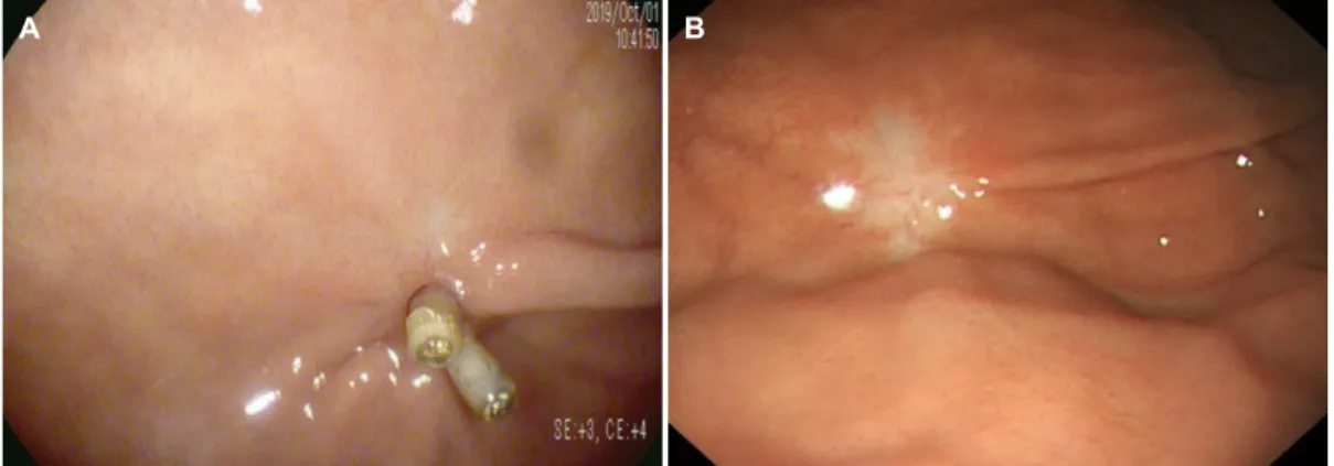 Fig. 5. Follow-up endoscopy findings. (A) The micro-perforated site had completely healed with a scar and two hemo-clips two months later.