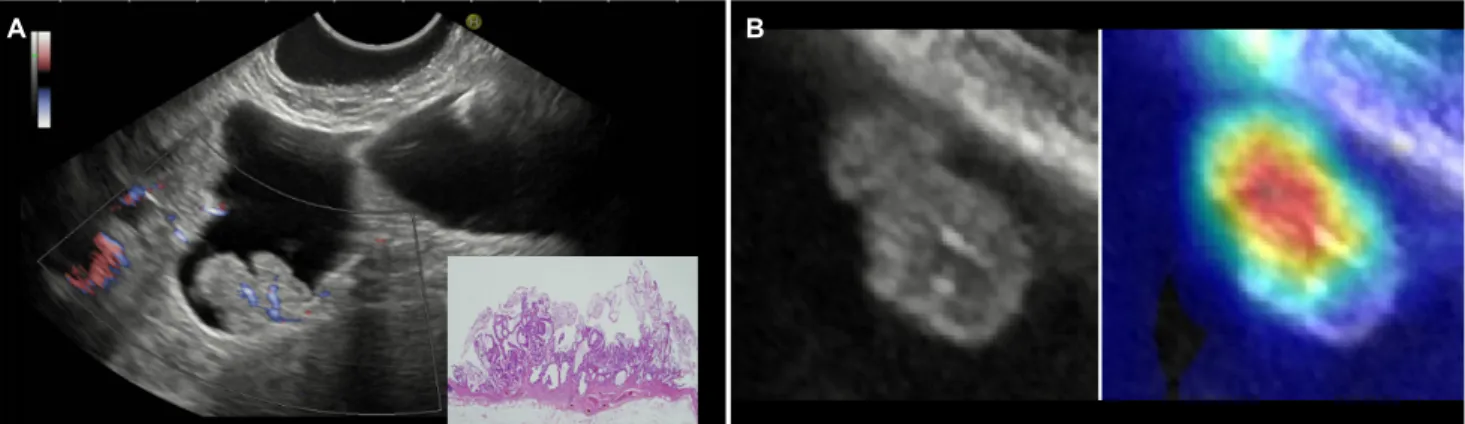 Fig. 3. (A) Color Doppler flow endoscopic ultrasonography image shows a strong continuous flow in an adenomatous polyp, which is compatible  with prominent small feeding arterioles in gallbladder polyps