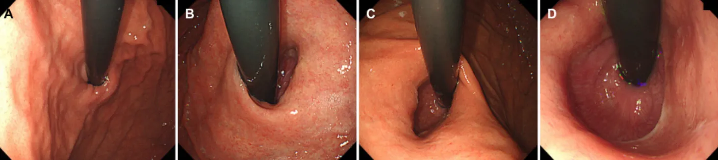Fig. 2. Representative images of the gastroesophageal flap valve (GEFV) grade. (A) Grade 0