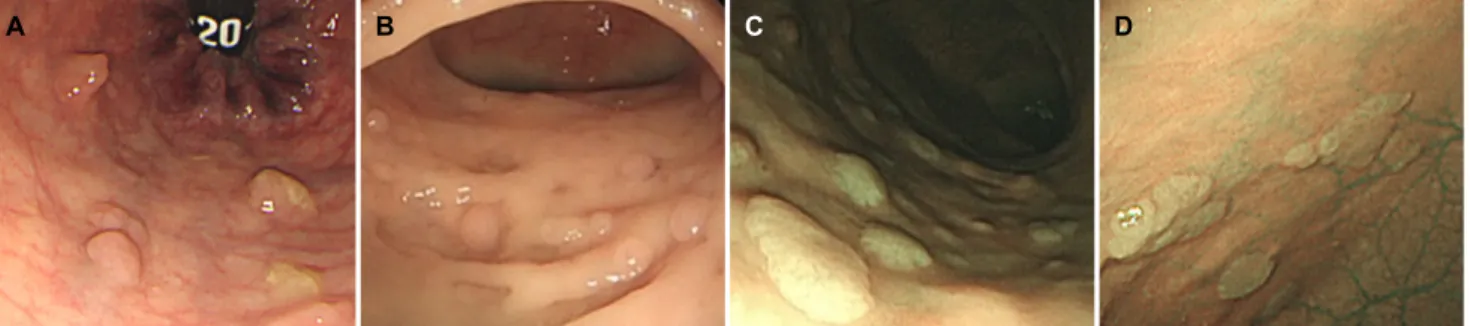 Fig. 2. Colonoscopic findings showing multiple polyps with variable sizes in the (A) rectum, (B) sigmoid colon, (C, D) descending colon