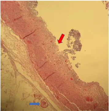 Fig. 2. Pathological findings (H&amp;E, 20): colon segment showing  extensive mucosal, submucosal necrosis (upper arrow), and  microthrombi (lower arrow).
