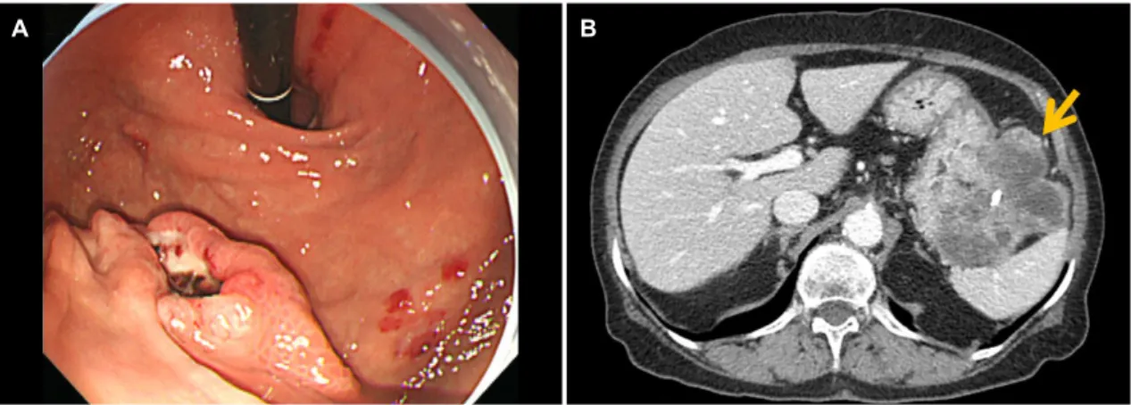 Fig. 1. Endoscopic images of the gastric lesion and abdominal computed tomography findings at the initial presentation