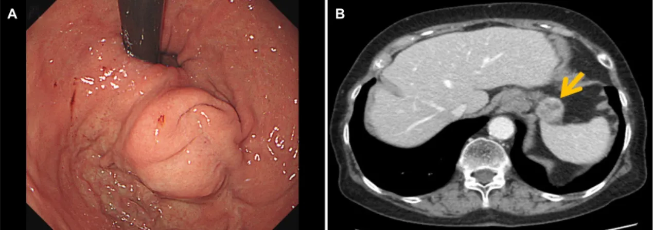 Fig. 3. Endoscopic images of the recurred gastric lesion and abdominal computed tomography findings at the first recurrence