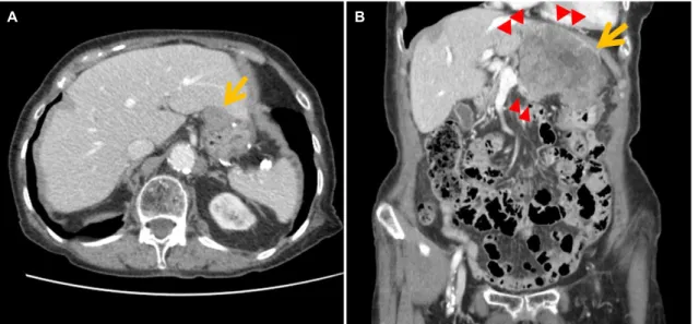 Fig. 5. Follow-up abdominal computed tomography findings after the second surgery. (A) A newly appeared 2.6-cm sized mass was found at  the gastric anastomosis site (arrow), 1.5 years after the second surgery