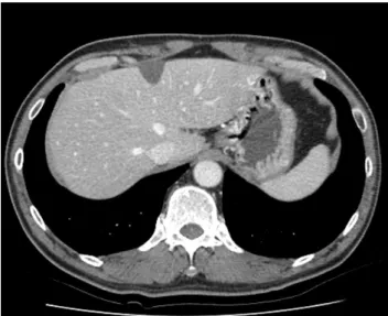 Fig. 4. Magnetic resonance imaging findings. (A) T1 weighted  imaging shows an approximately 4.8×3.0 cm sized low signal  intensity lesion with an irregular thickness of the wall