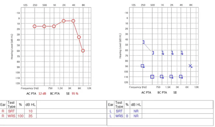 Fig. 1. After 13 days from 6th cycle of a FOLFIRINOX regimen, audiometry revealed severe to profound hearing loss of the left ear.