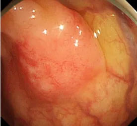 Fig. 2. Microscopic findings. (A) Endoscopic biopsy specimens show a diffuse and dense infiltration of small-sized lymphocytes and a  lymphoepithelial lesion in the colonic mucosa (H&amp;E staining, ×400)