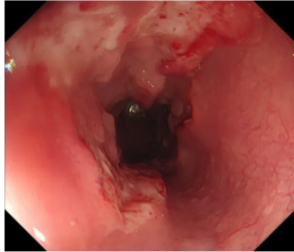 Fig. 1. Upper endoscopic findings at the initial presentation  revealing a large ulcerative lesion with an irregular border,  occupying more than 70% of the circumference of the esophagus.