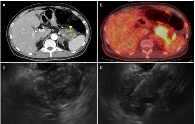 Fig. 1. Pancreatic candidiasis in 37-year-old man. (A) Axial computed tomography (CT) scan reveals a 4.5×4.3 cm sized irregular heterogenous  enhancing mass (arrow heads) with internal necrosis (asterisk) in the tail of pancreas