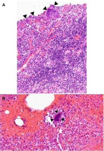 Fig. 2. Excised specimen showing a perforated abscess (white arrows) and a sharp fishbone was retrieved from the abscess (not shown)