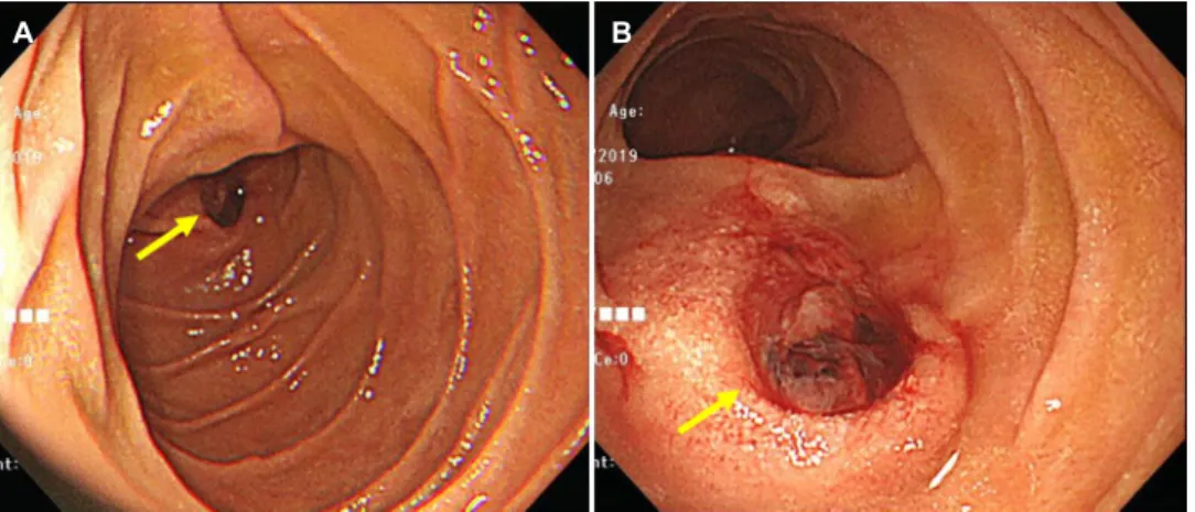 Fig. 1. Duodenal ulcer with a pulsating huge vessel at the inferior duodenal flexure. (A) Duodenal ulcer as viewed from the second portion  of the duodenum