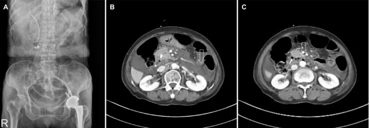 Fig. 3. Abdominal X-ray and abdominal computed tomography findings. (A) Abdominal X-ray shows a retroperitoneal free air outlining the psoas muscle