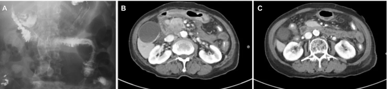 Fig. 5. Upper gastrointestinal (UGI) series and abdominal computed tomography findings