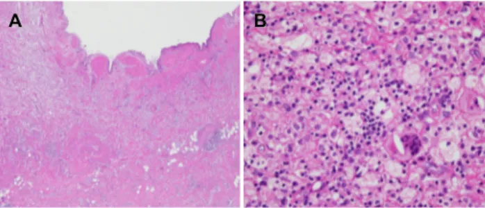 Fig. 5. Microscopically, (A) thickened gallbladder wall revealed a  relatively preserved mucosal epithelium and partly disrupted  muscular layers (left side), in which collections of lipid-laden  macrophages were found admixed with mixed inflammatory cells