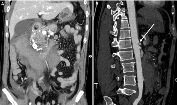 Fig. 3. Vascular-aorta computed tomography angiography after 2 days of transarterial embolization