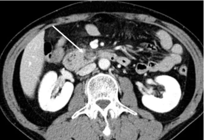 Fig. 5. Computed tomography performed 6 months after discharge.