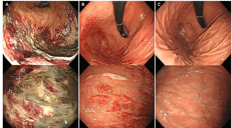 Fig. 1. Endoscopic findings. (A) Initial endoscopic image showing a huge ulcer with exudate and pale mucosal discoloration accompanied  by redness of the surrounding mucosa in the gastric fundus and high body