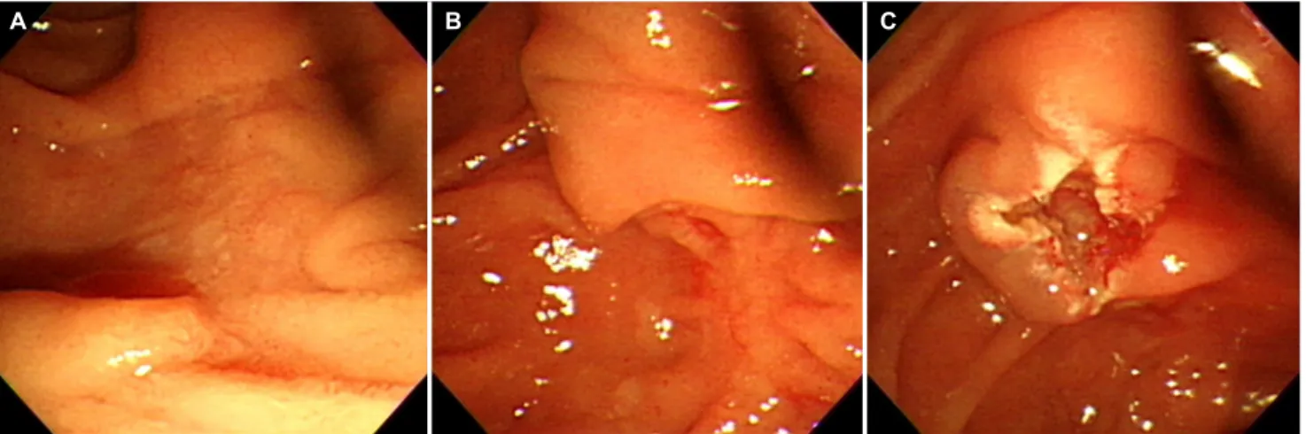 Fig. 3. Aspiration was performed in order to identify the bile reflux, but pure blood was collected indicating possible cannulation of the portal vein.력은  없었다