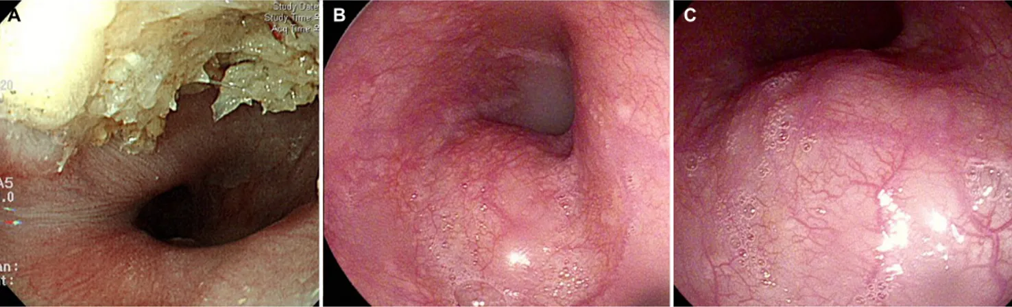 Fig. 1. (A-C) Endoscopic appearance of the esophageal leiomyoma.