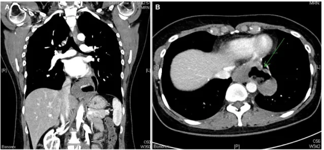 Fig. 4. Specimen of the enucleation done showing (A) a large round shape leiomyoma. (B) The cavity in the center of the mass can be seen  in the cross section.