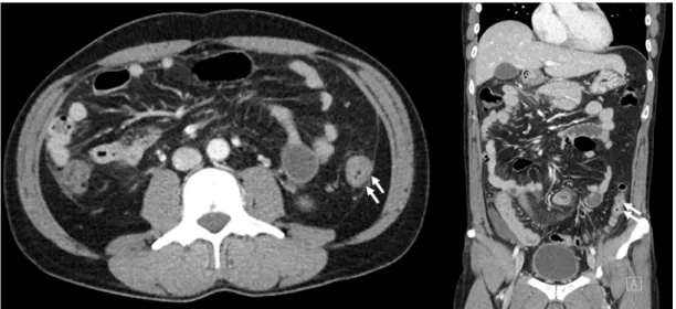 Fig. 1. Computed tomography findings were nonspecific. Mild wall thickening with mucosal enhancement in the descending colon.
