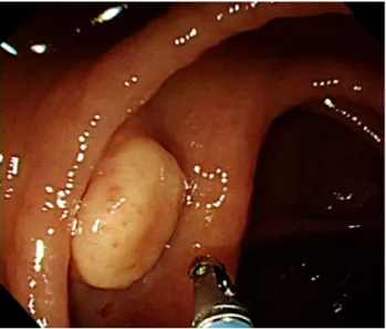 Fig. 1. Colonoscopy findings. A 1.5 cm-sized protruding mass with  a yellow granular surface can be seen in the proximal ascending  colon
