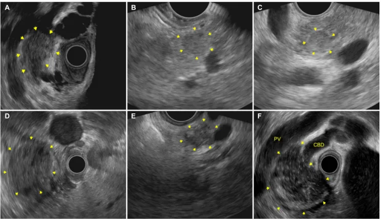 Fig. 1. Endoscopic ultrasound image of different solid pancreatic tumors (arrows of A-F)