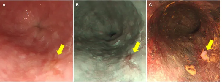 Fig. 4. Endoscopic ultrasound examination. A 6 mm sized isoechoic  lesion was confined in the 1st layer of the esophageal wall.
