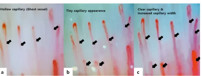Fig. 5. Example of capillary image change (a: pre-walking, b: non-vibration shoes and c: vibration shoes)