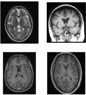 Fig.  4.  MRI  image  of  normal  brain         3.5  이미지  전처리 총  데이터셋의  개수가  적기  때문에,  Keras의  ImageDataGenerator 함수를 활용하여 데이터셋을 증 식시킨다