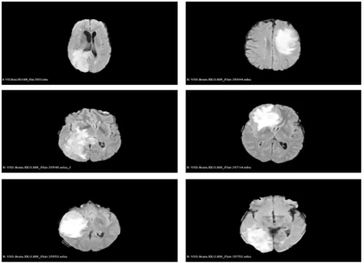 그림 1. BRATS 2015 데이터(MRI, Image size: 512×512 pixels, Voxel size: 1×1×1 mm).