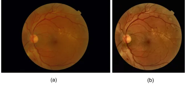 Fig. 1. Typical example of original and preprocessed retinal image. (a) original image, (b) preprocessed image.