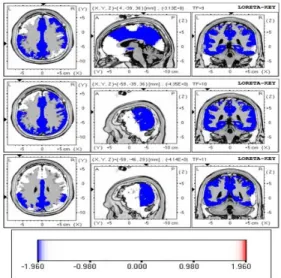 Fig.  5.  LORETA  results,  9-11  Hz