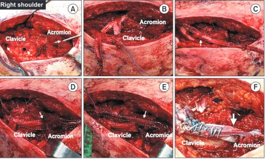 Fig. 2. Representative intraoperative images of a right shoulder. (A) Creating the conoid and trapezoid tunnels (white dotted arrow) over the distal  clavicle and reducing the acromioclavicular (AC) joint with temporary guide-pin fixation via the acromion 