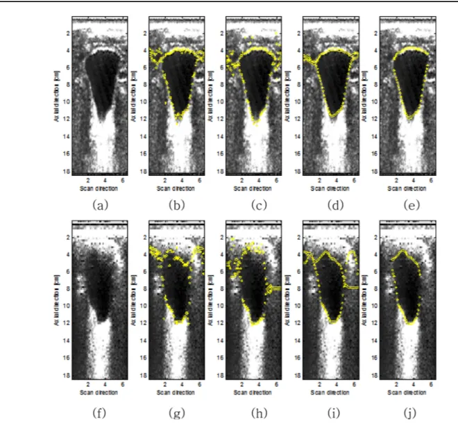 Fig. 10. Bladder segmentation procedure in two ultrasound images. (a),(f) Two ultrasound images of a bladder, (b),(g) Results of segmentation using only the original images, (c),(h) Results of segmentation using original and gradient images, (d),(i) Result